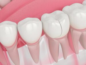Can TMJ Cause Tooth Pain crack Can TMJ Cause Tooth Pain crack