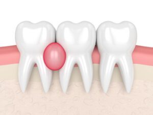 How Soon Will Antibiotics Stop Tooth Pain gum pain
