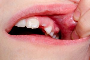 How Soon Will Antibiotics Stop Tooth Pain infection