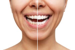 Teeth Whitening Before And After images