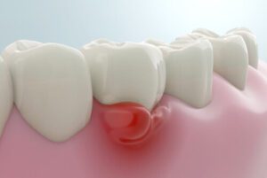 how do i know if i need a root canal or a filling gums