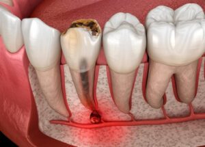 how do i know if i need a root canal or a filling pulp