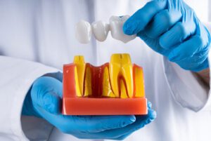 What is a Bridge in Dental Work procedure