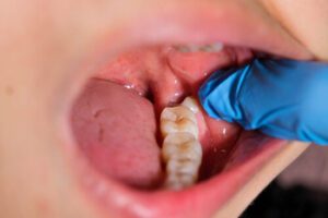 White Stuff in Wisdom Tooth Hole infection
