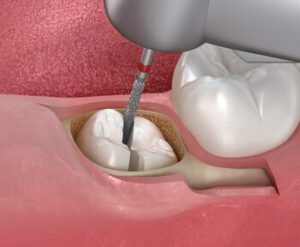 White Stuff in Wisdom Tooth Hole removal