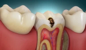 Tooth Broke After Root Canal Before Crown cavity Tooth Broke After Root Canal Before Crown cavity