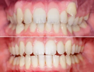 before and after effects of orthodontic procedure
