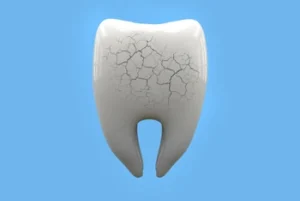 How To Remove Tooth Decay Yourself cracks