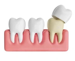 What Is a Tooth Filling crown