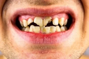 Can You File a Chipped Tooth cause