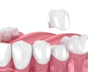 Dental Crown for Broken Tooth application