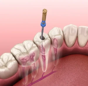 Root Canal Pain procedure