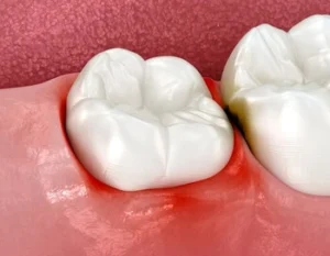 What Does Wisdom Teeth Pain Feel Like swelling