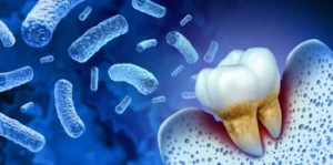 What Can Cause Tooth Decay bacteria