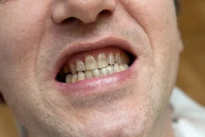 patient showing his decayed teeth