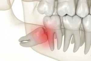 wisdom tooth pain impacted