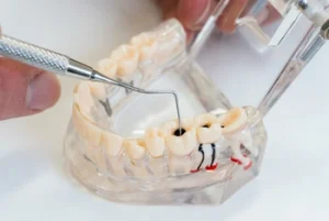 Dos and Don'ts After Tooth Filling sensitivity
