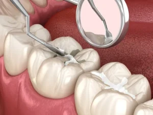Types of Dental Fillings material