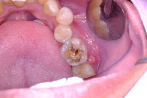 What Can Cause Tooth Decay early