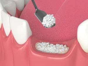 Diagram of socket preservation showing bone graft material placed into an empty tooth socket, topped with a collagen membrane
