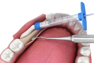 How to Speed Up Bone Graft Healing procedure