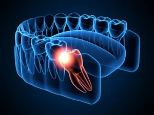 Broken Wisdom Tooth pain