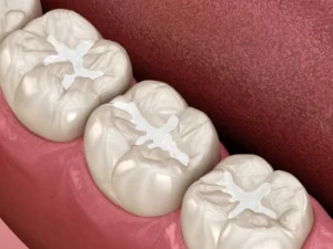 filling chipped tooth procedure