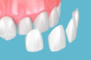 why did my tooth veneers stains